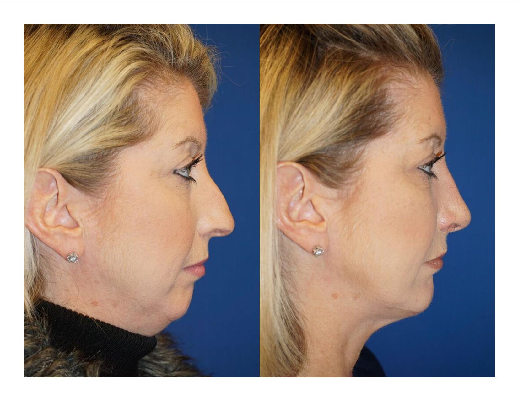 Chin Implant
