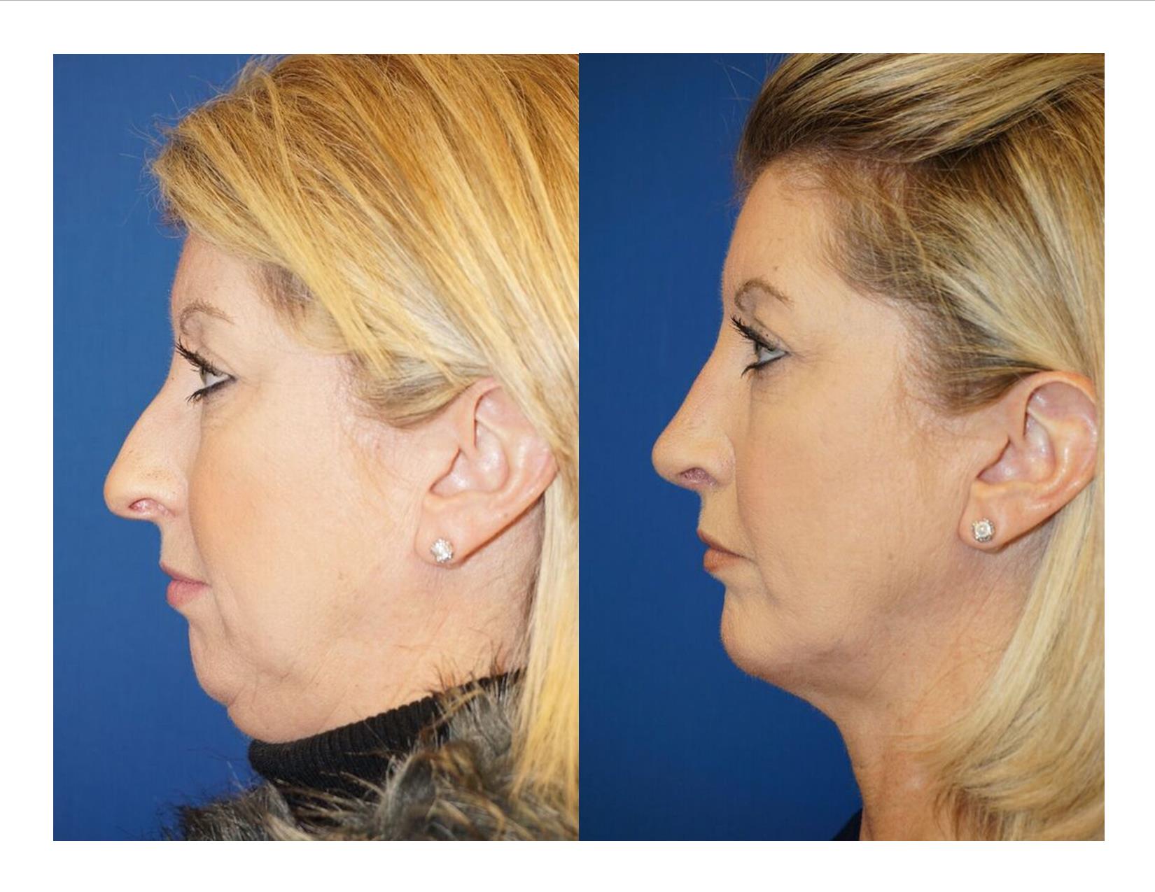 Chin Implant 2