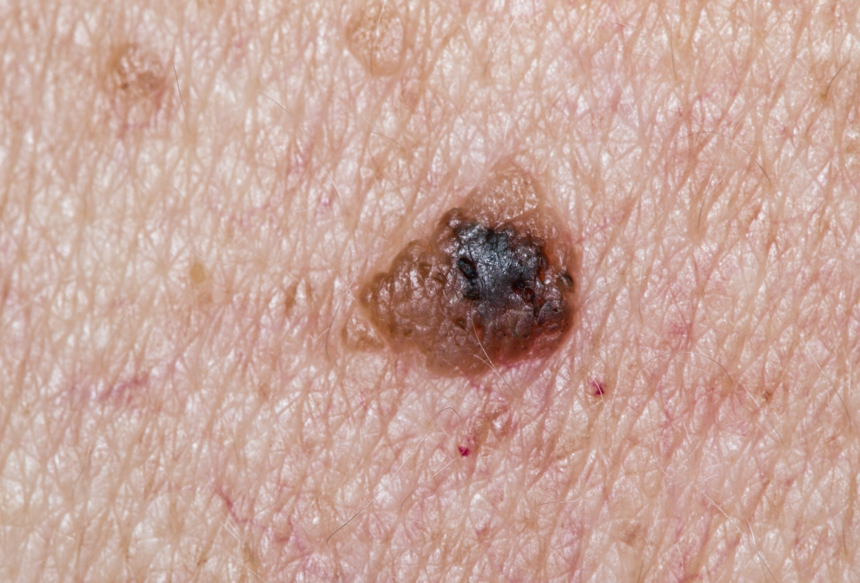 skin cancer