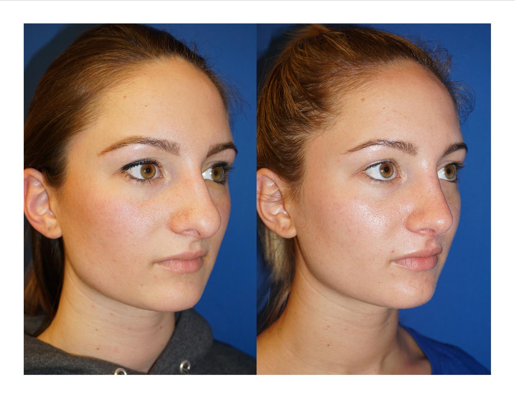 Rhinoplasty 1 Image 2