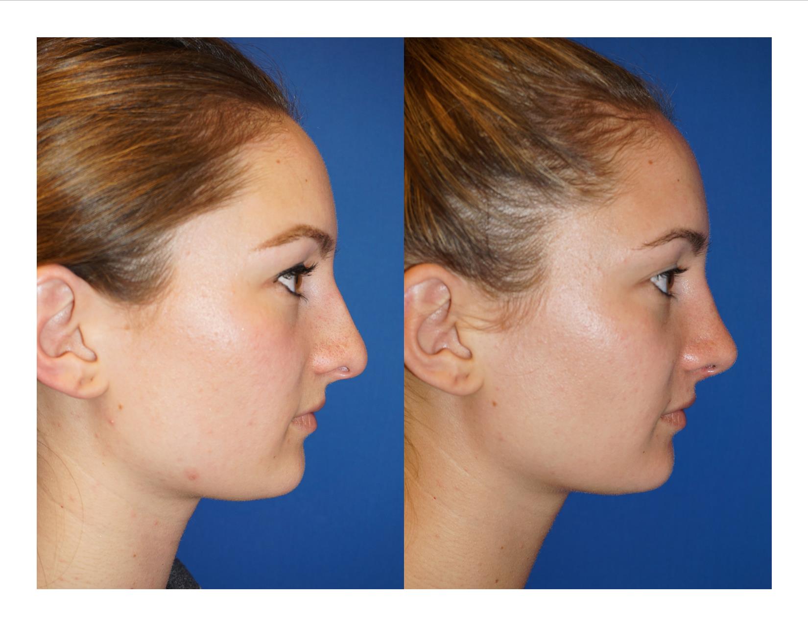 Rhinoplasty 1 Image 3