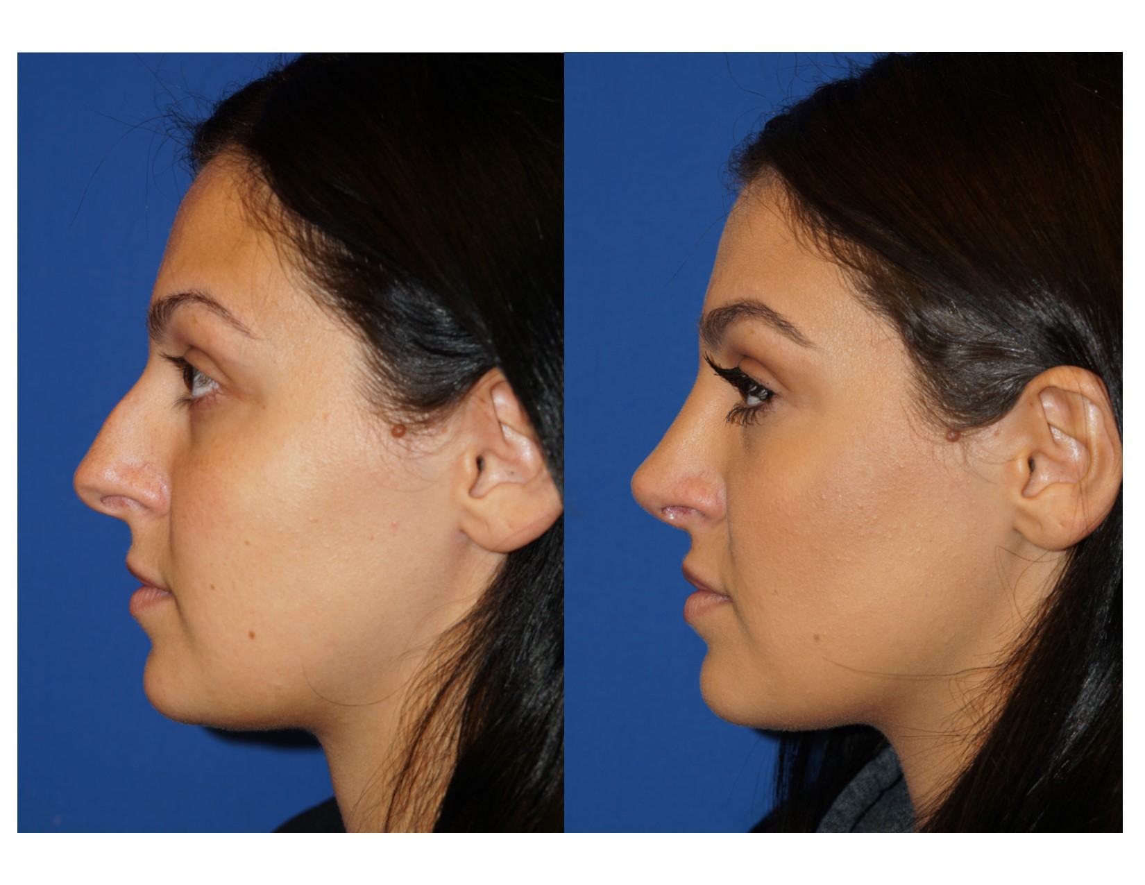 Rhinoplasty 6 Image 1 