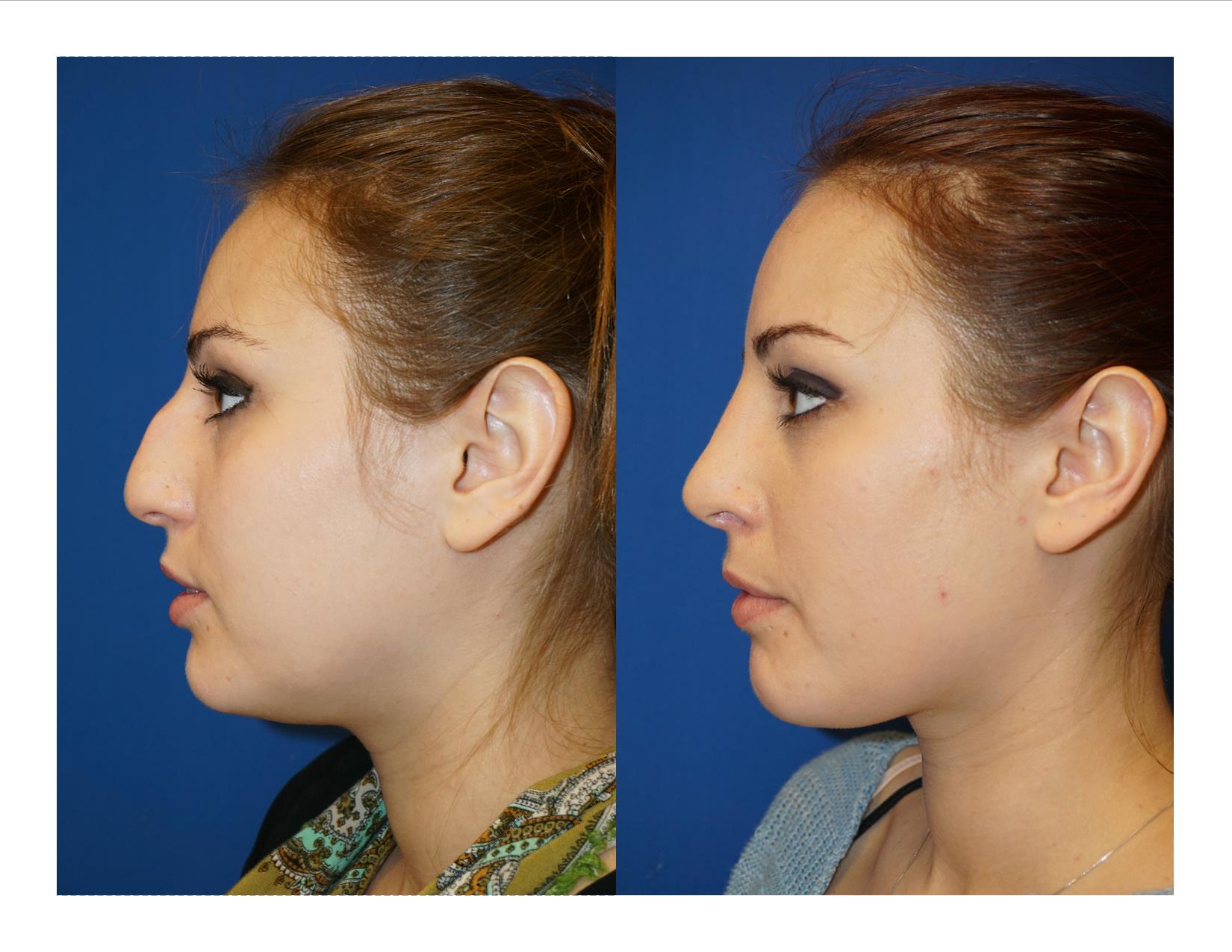 Rhinoplasty 12 Image 1 