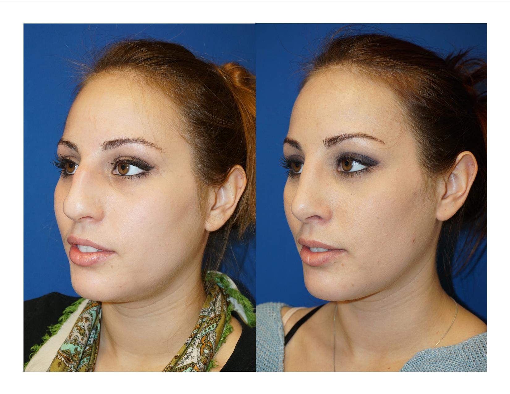 Rhinoplasty 12 Image 2