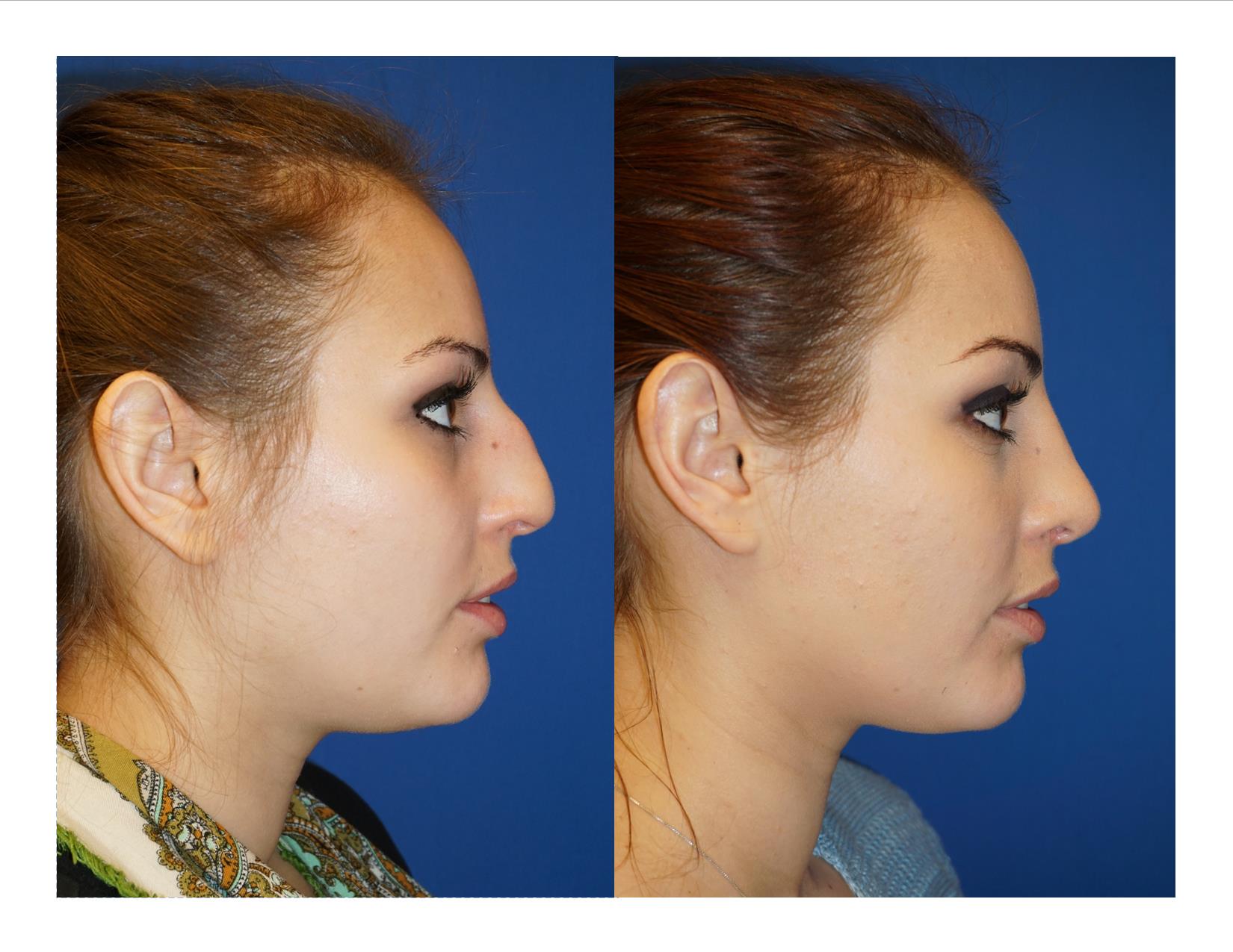 Rhinoplasty 12 Image 5