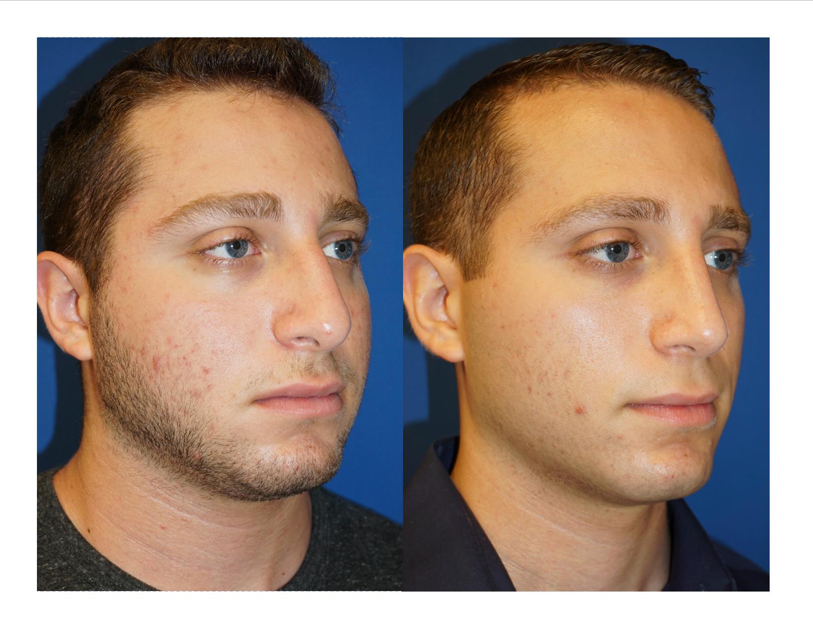 Rhinoplasty 2 Image 2