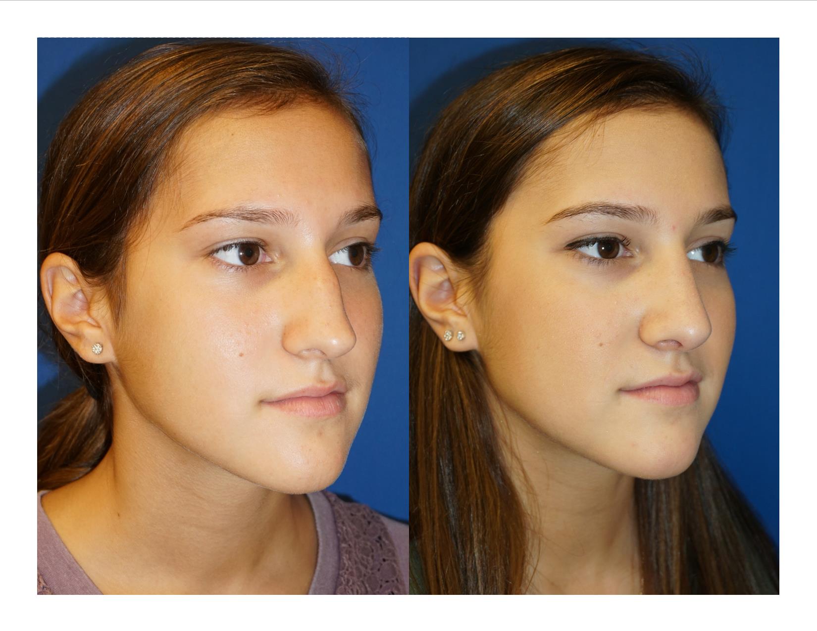 Rhinoplasty 9 Image 2