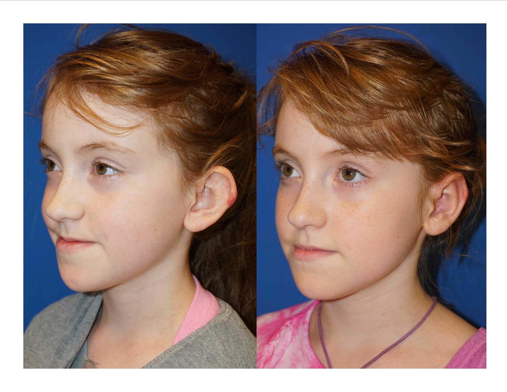 Image 2 Otoplasty 1
