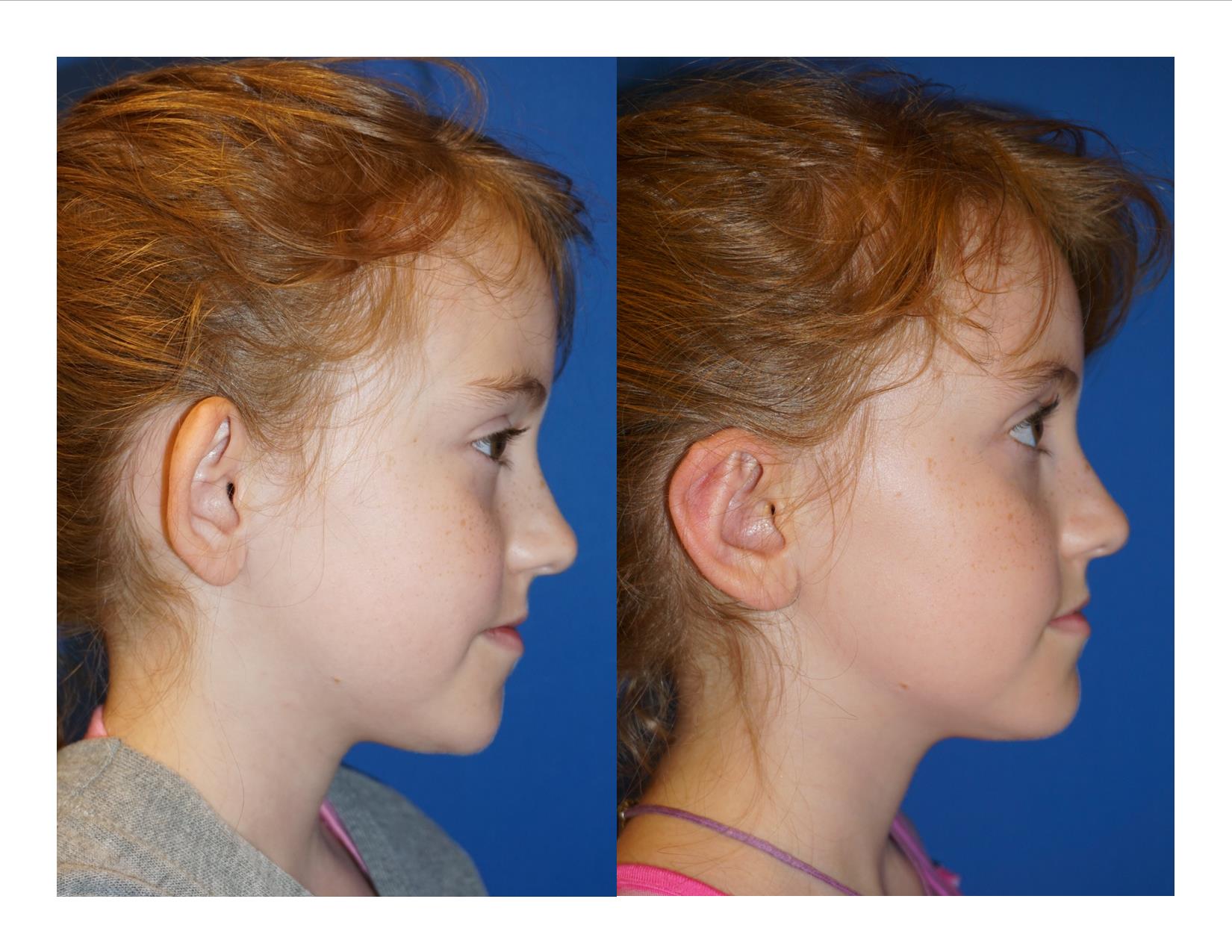 Image 5 Otoplasty 1