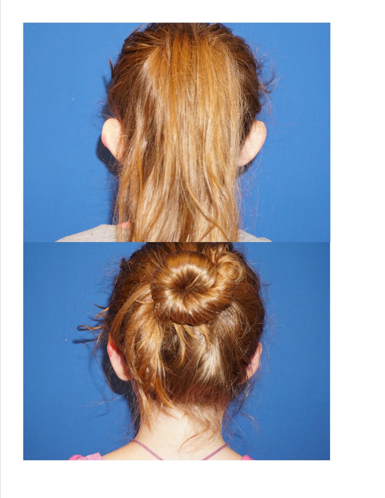 Image 6 Otoplasty 1