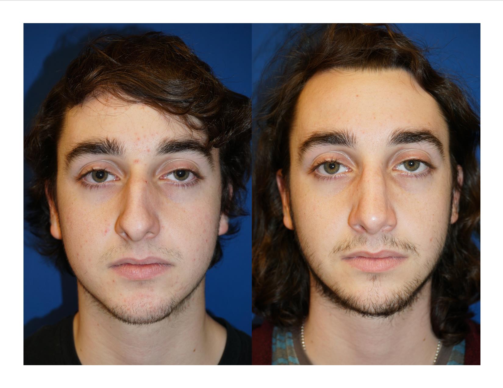 Rhinoplasty 8 Image 1 