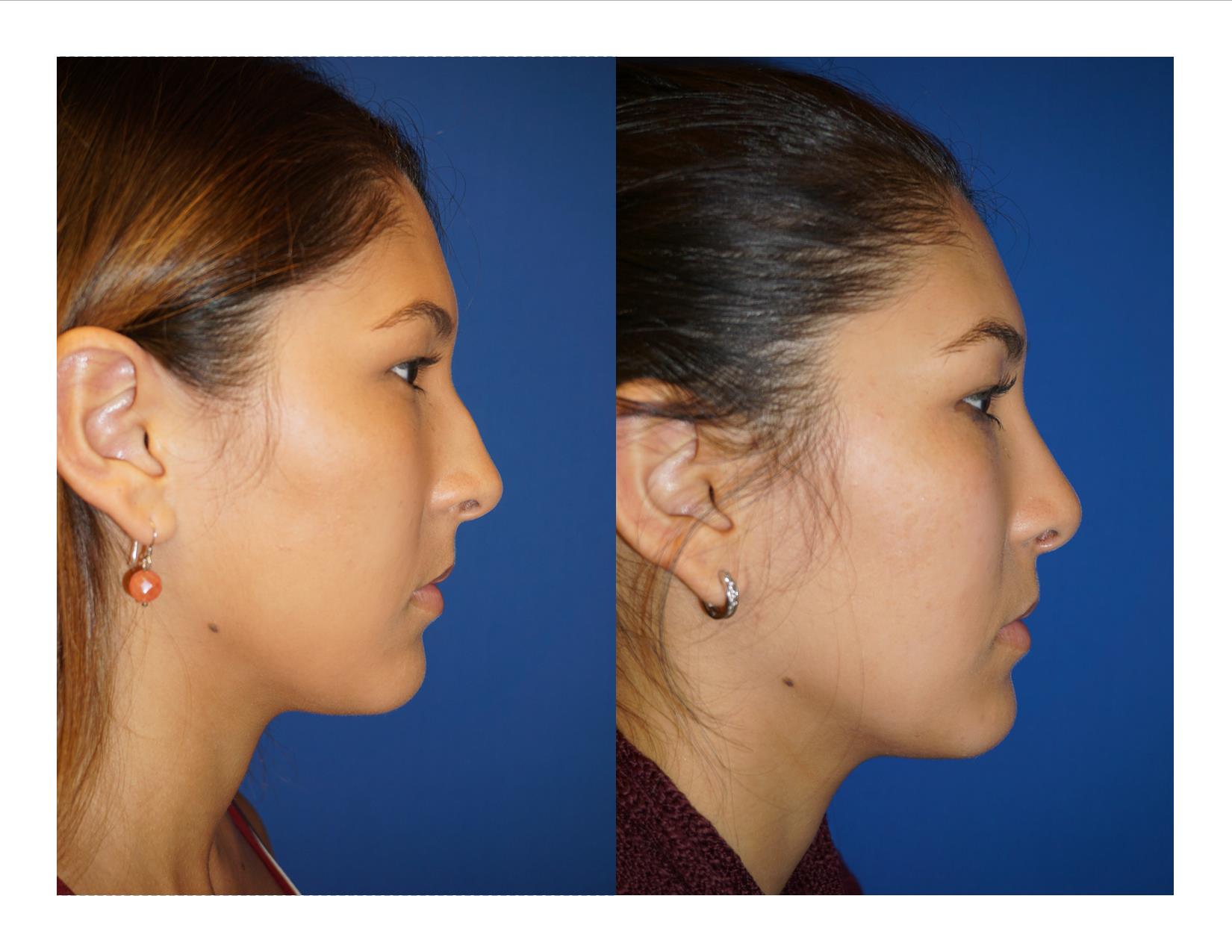 Rhinoplasty 11 Image 3
