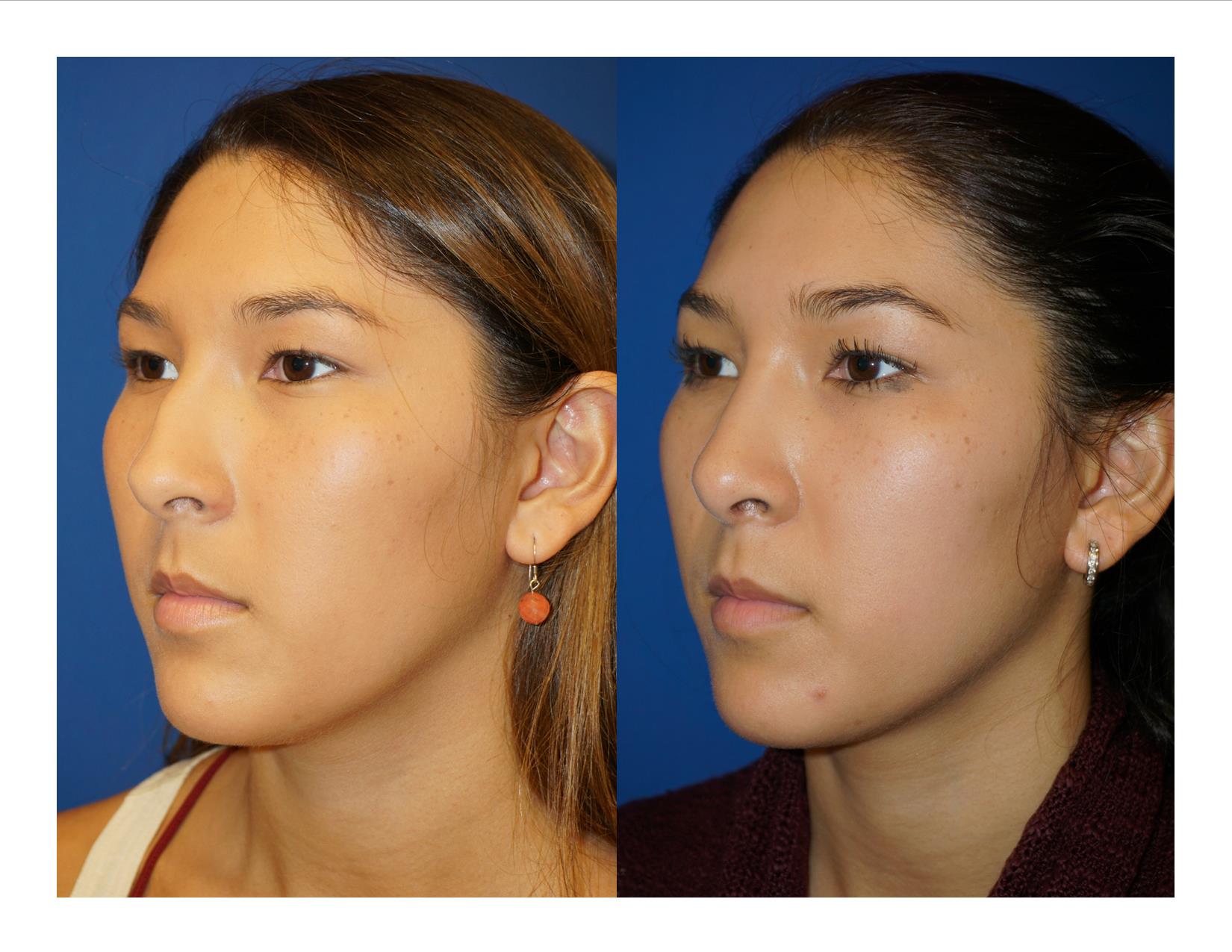 Rhinoplasty 11 Image 4
