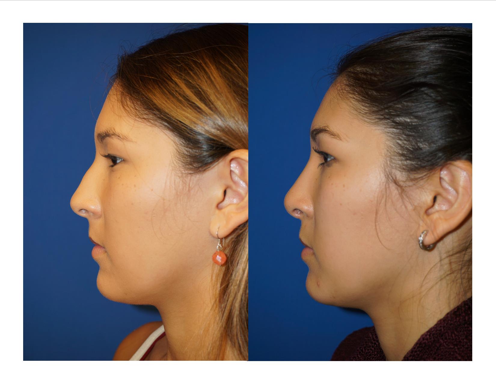 Rhinoplasty 11 Image 5