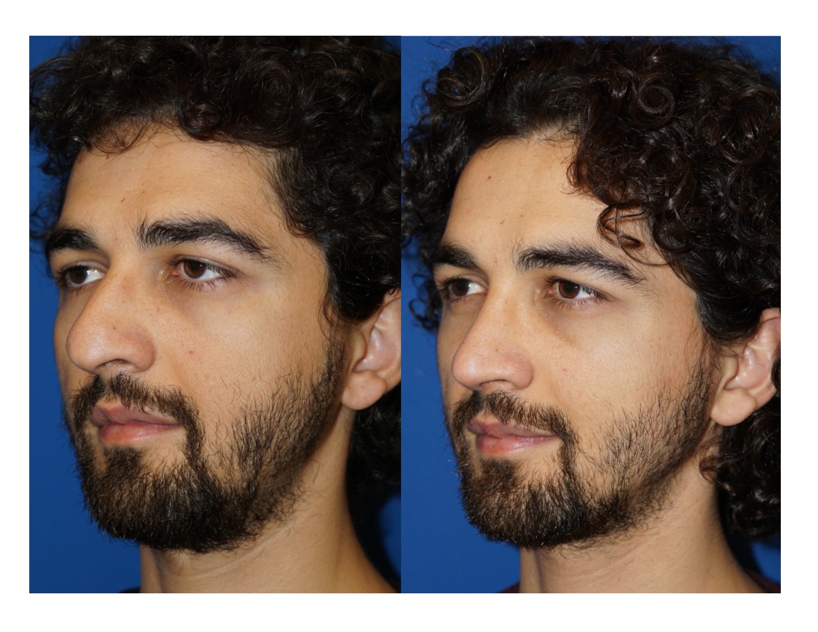 Rhinoplasty 13 Image 2