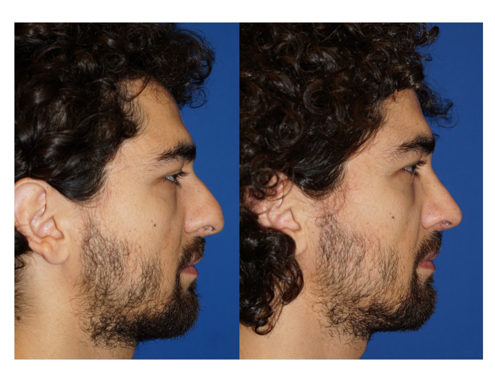 Rhinoplasty 13 Image 5