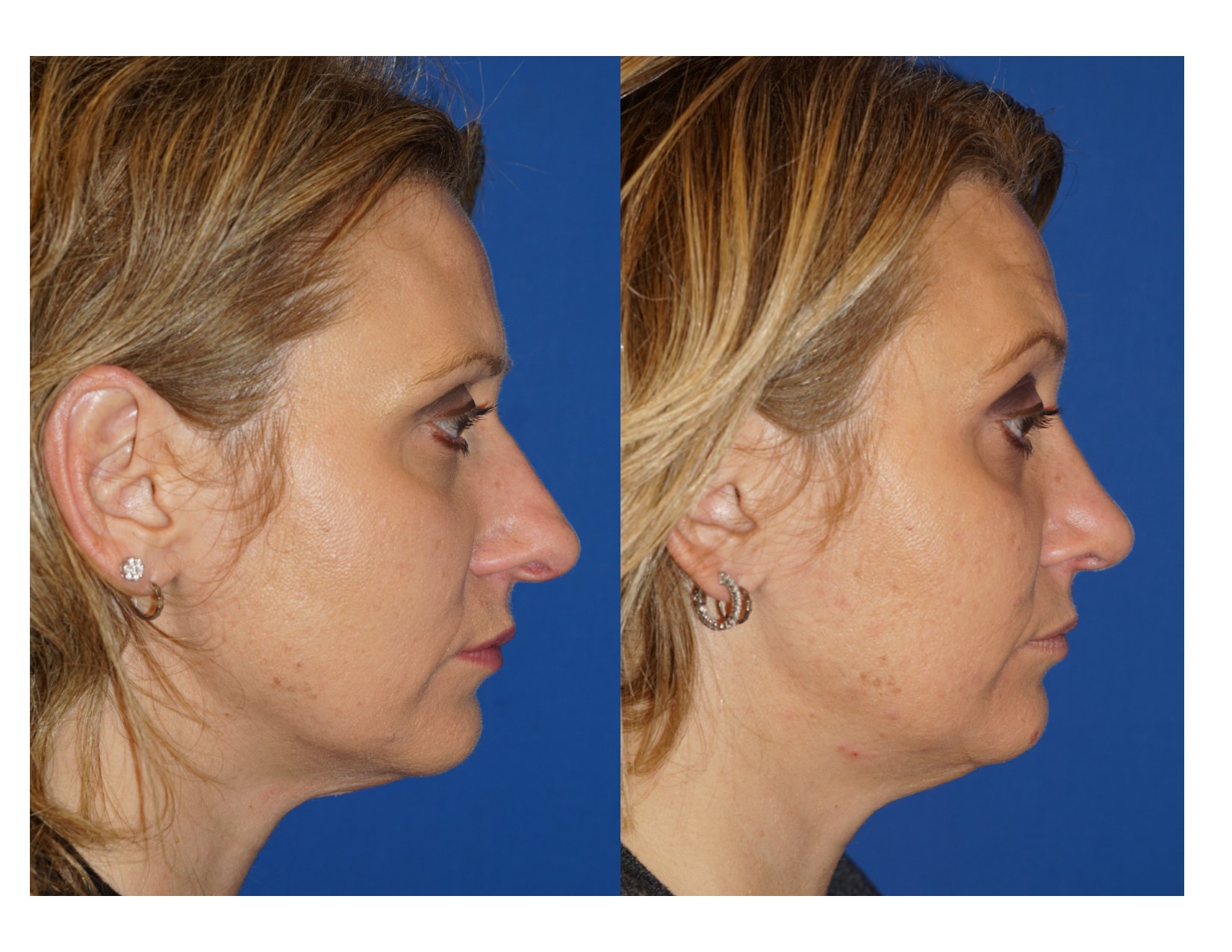 Rhinoplasty 14 Image 3