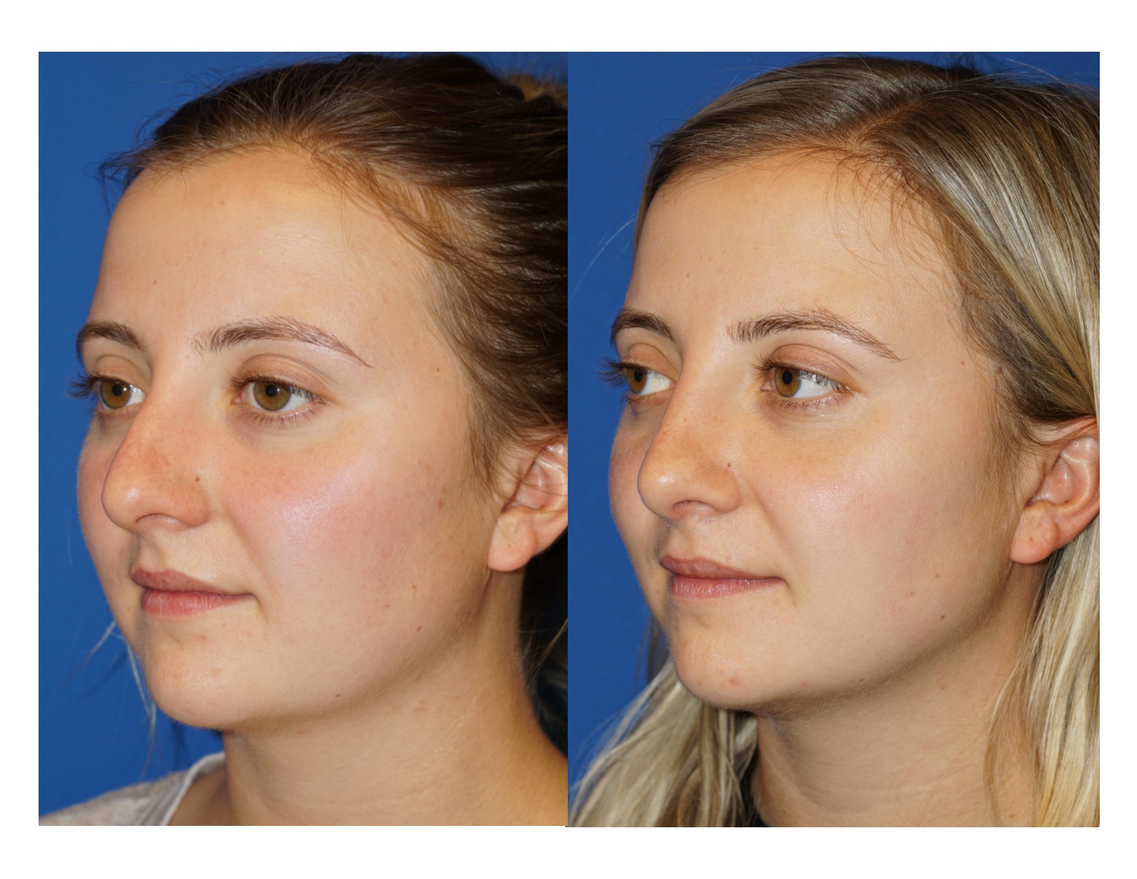 Rhinoplasty 15 Image 4