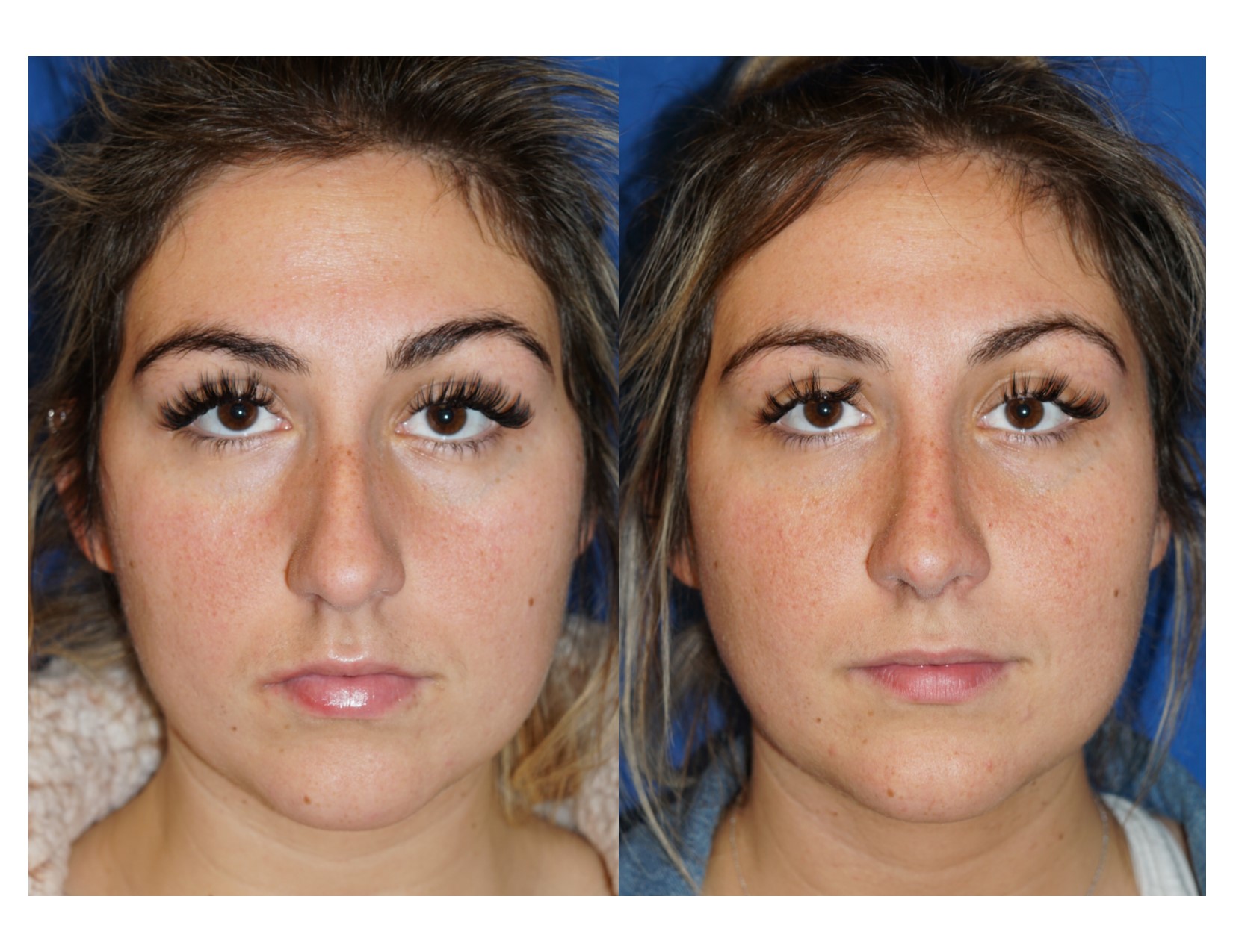 rhinoplasty3_1_0