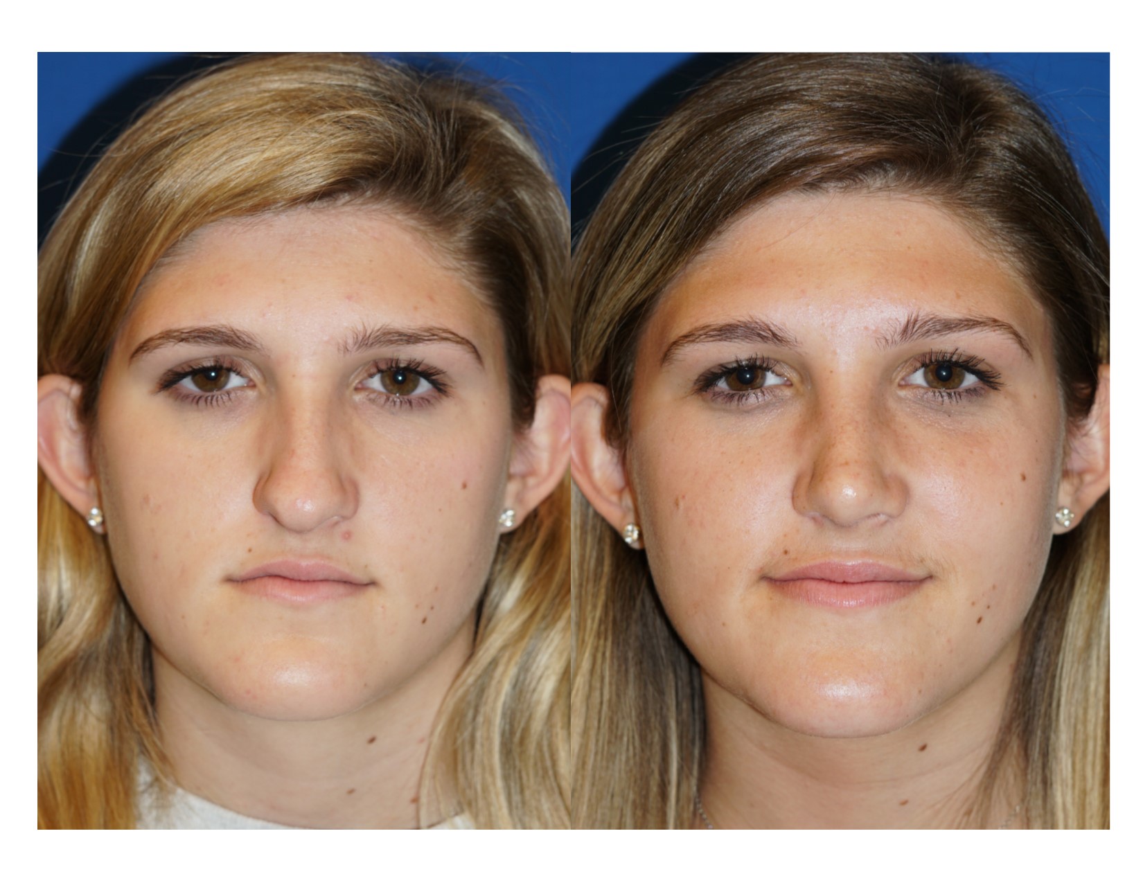 Rhinoplasty 4 Image 3
