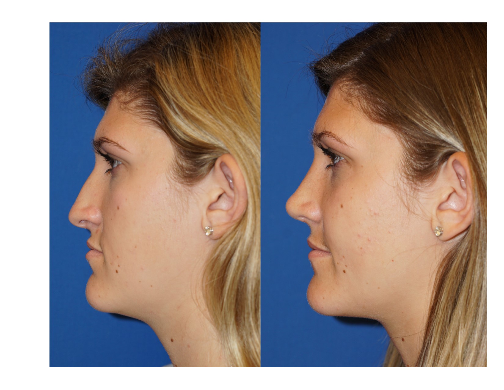 Rhinoplasty 4 Image 1