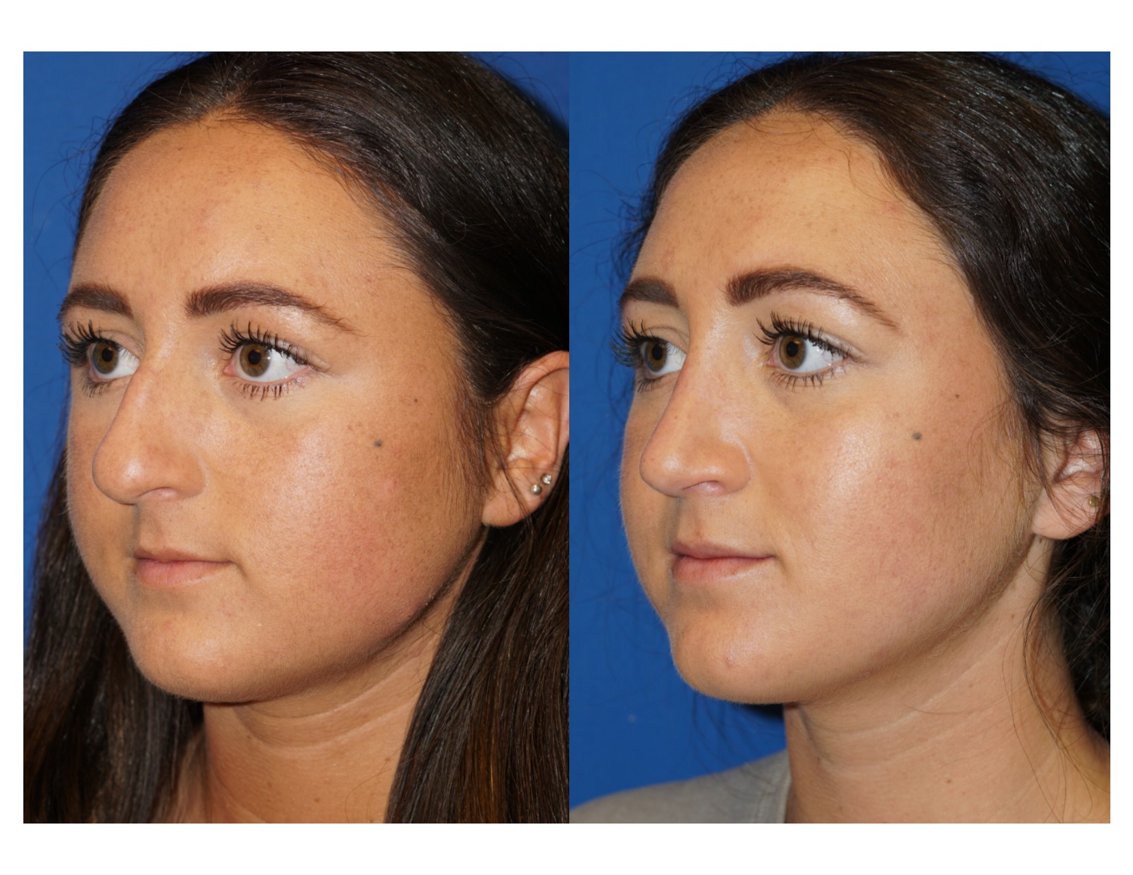 Rhinoplasty 5 Image 4