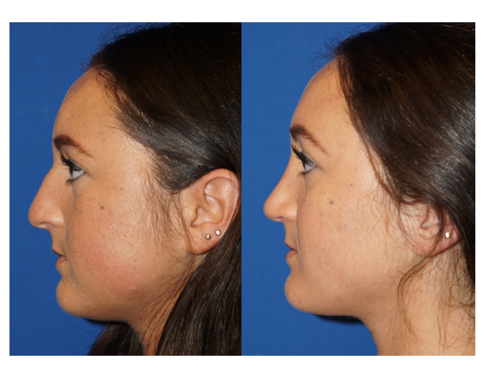 Rhinoplasty 5 Image 5