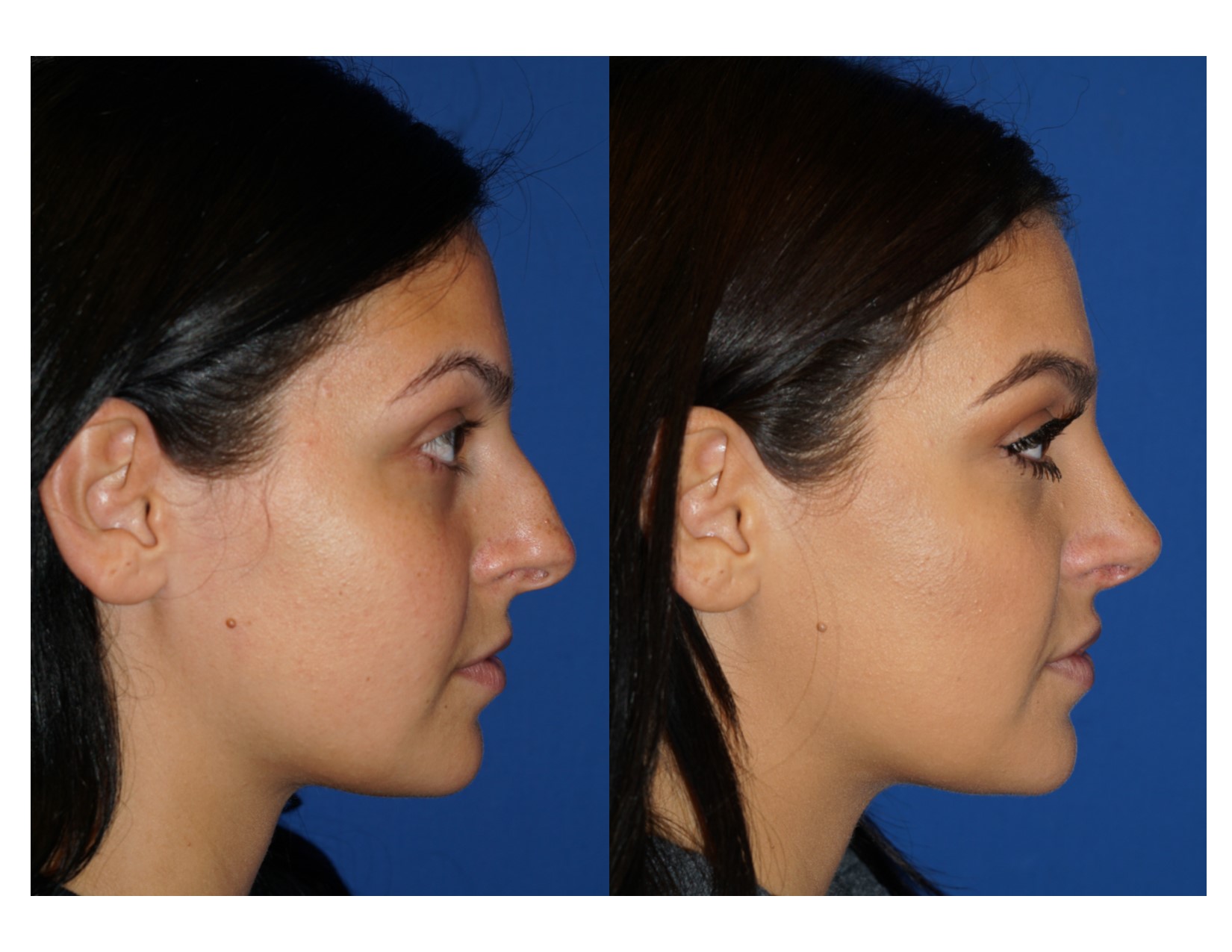 Rhinoplasty 6 Image 5